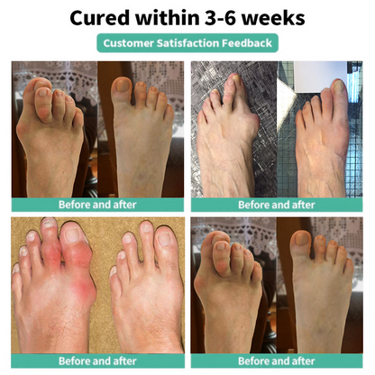 🏅Natravor® Relief Botanical Bunion Comfort Patcht👠💃（Physical Stretch Support + Botanical Comfort Formula)